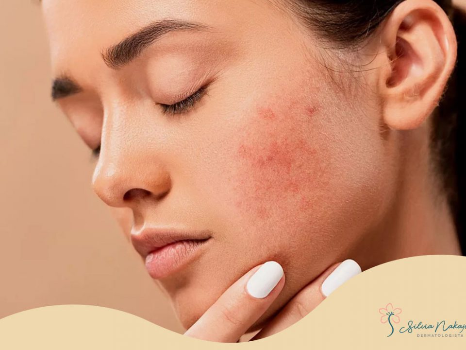 tratamento de acne na adolescencia