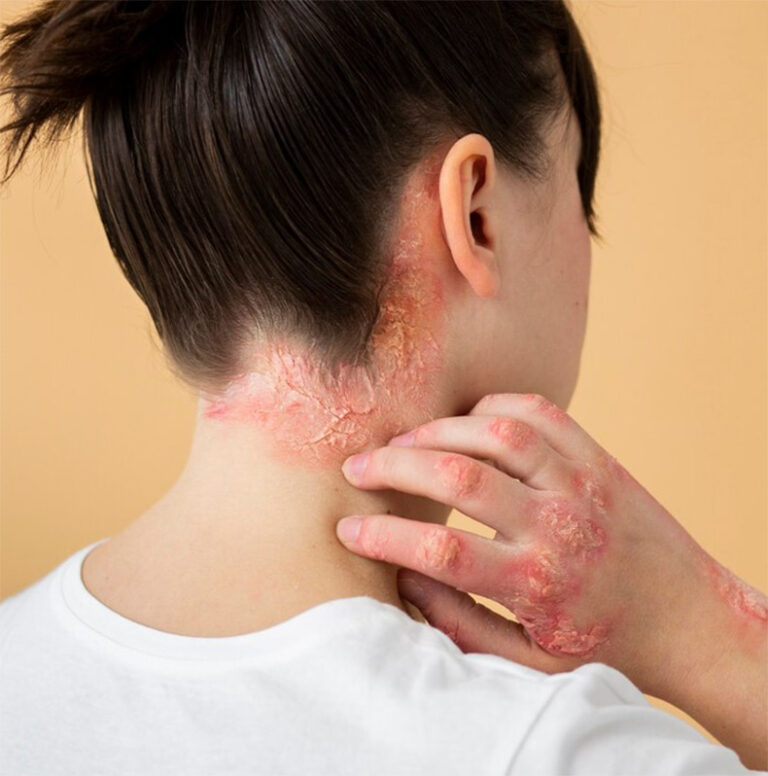 psoriase no pescoço, mãos e nuca