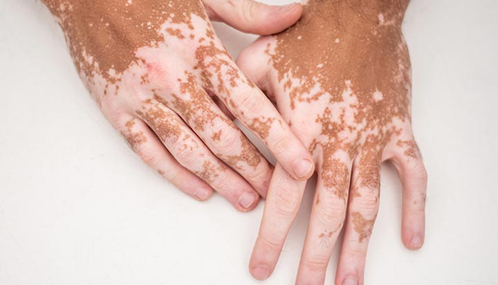 medica trata vitiligo manaus