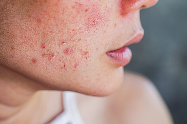 tratamento de acne da mulher adulta