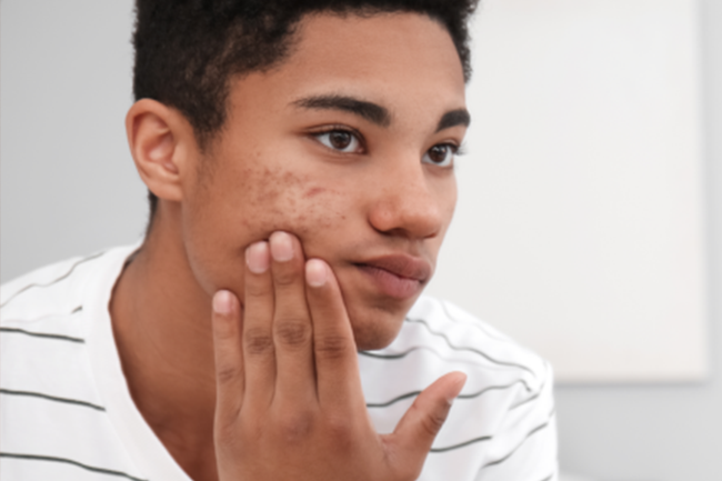 acne na adolescencia