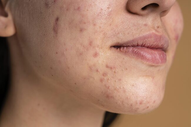 tratamento de acne severa